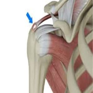 رسوب کلسیم شانه